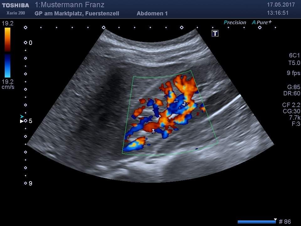 Ultraschalluntersuchung der Niere